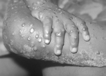 Foto: CDC's Public Health Image Library