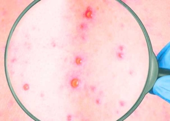 Santa Cruz registra primer caso de viruela del mono en un niño