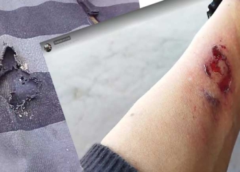 Brazo herido del periodista Nicolás Sanabria